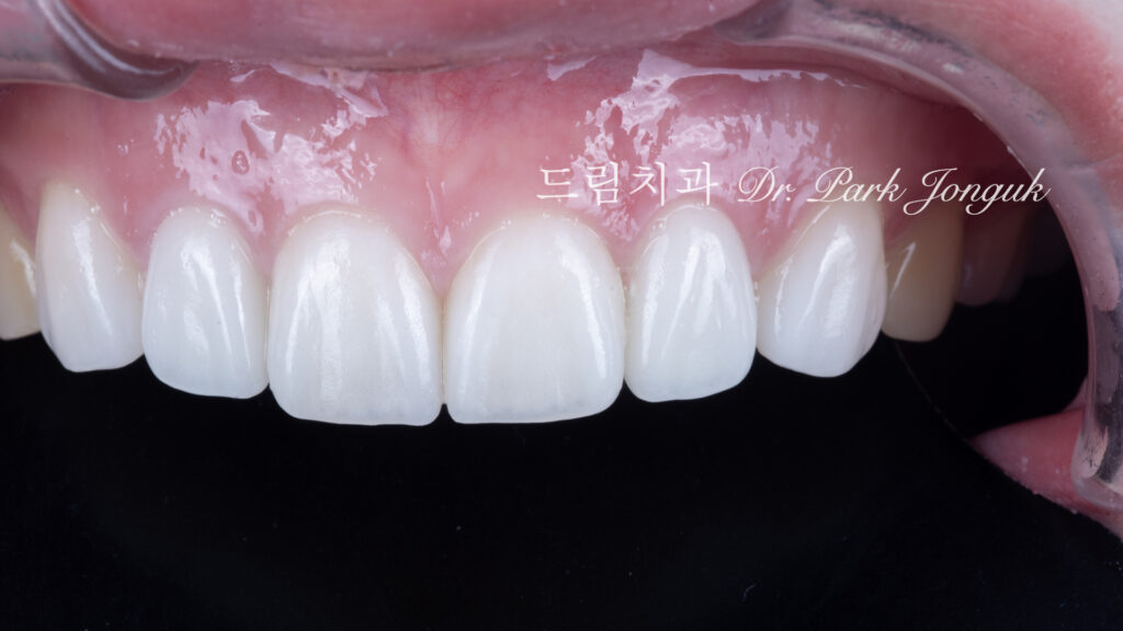 올세라믹 크라운 재시술, All-Ceramic Crown Remake, 무삭제 라미네이트, No-Prep Laminate, 왜소치, Peg-Shaped Lateral Incisors, 라미네이트 재시술, Laminate Remake, 측절치 크라운, Lateral Incisor Crown