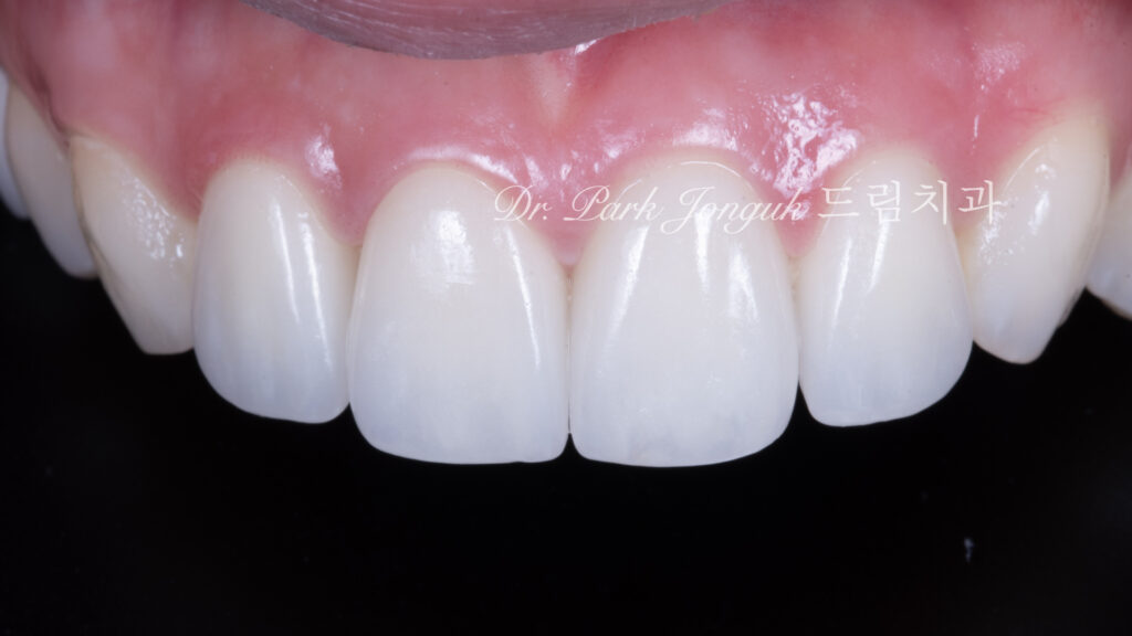 라미네이트 진단, Laminate Diagnosis, 정밀 진단, Precise Diagnosis, 얼굴 분석, Facial Analysis, 치아 비율, Tooth Proportion, 디지털 분석, Digital Analysis, 치료 예측, Treatment Prediction
