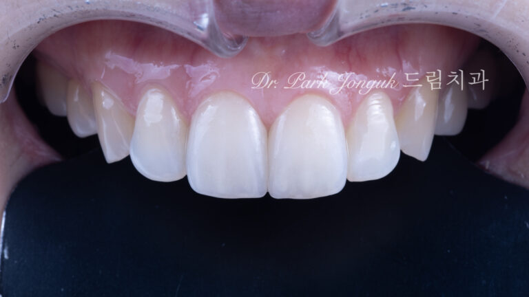 앞니 라미네이트, Anterior Laminate Veneer, 라미네이트 잘하는 곳, Expert Laminate Clinic, 자연스러운 라미네이트, Natural Laminate, 다층 빌드업, Multi-Layer Build-Up, 백금박 라미네이트, Platinum Foil Veneer
