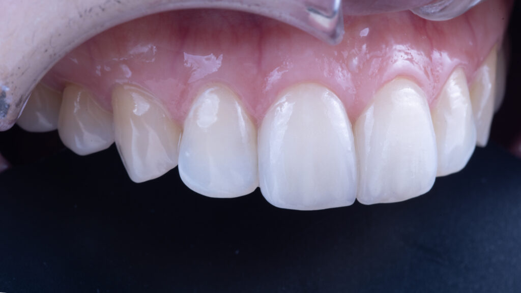 앞니 라미네이트, Anterior Laminate Veneer, 라미네이트 잘하는 곳, Expert Laminate Clinic, 자연스러운 라미네이트, Natural Laminate, 다층 빌드업, Multi-Layer Build-Up, 백금박 라미네이트, Platinum Foil Veneer