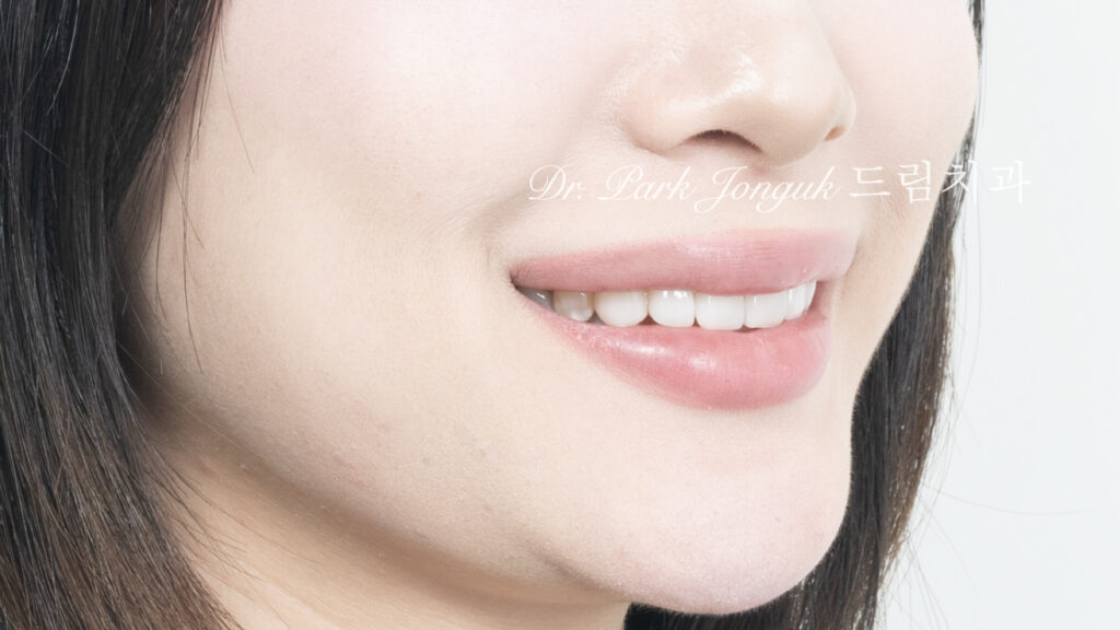 선천적 치아 변색, Congenital Tooth Discoloration, 치아 얼룩, Tooth Mottling, 내인성 변색, Intrinsic Discoloration, 미백 한계, Bleaching Limitation, 변색 차단 라미네이트, Discoloration Masking Veneer