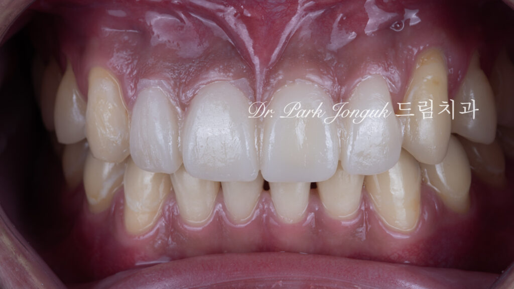 깨진 치아 라미네이트, Laminate for Fractured Teeth, 부식된 치아, Eroded Teeth, 역류성 식도염, GERD, 샌드위치 테크닉, Sandwich Technique, 무삭제 라미네이트, No-Prep Laminate, 교정 후 라미네이트, Post-Orthodontic Laminate