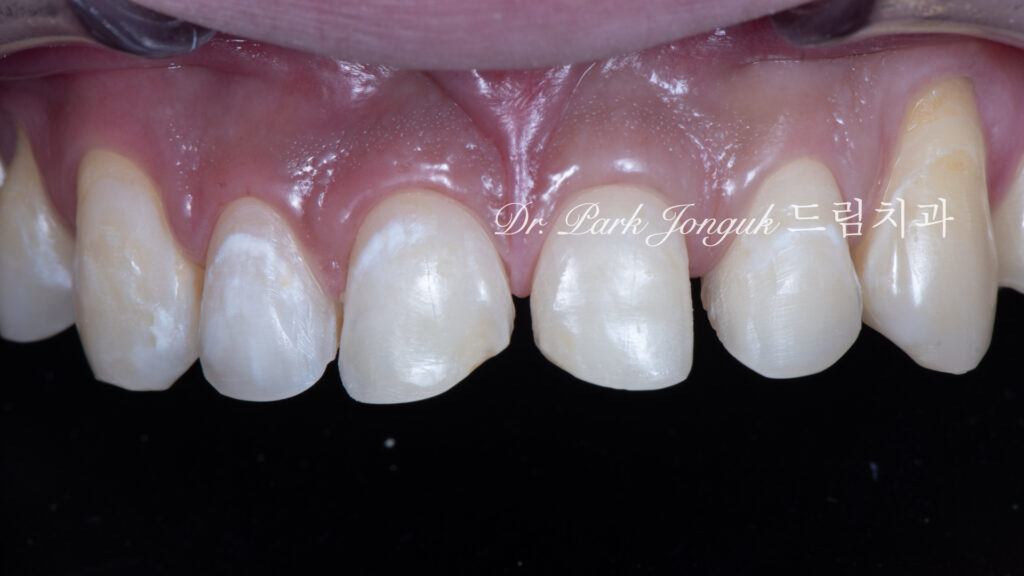 깨진 치아 라미네이트, Laminate for Fractured Teeth, 부식된 치아, Eroded Teeth, 역류성 식도염, GERD, 샌드위치 테크닉, Sandwich Technique, 무삭제 라미네이트, No-Prep Laminate, 교정 후 라미네이트, Post-Orthodontic Laminate