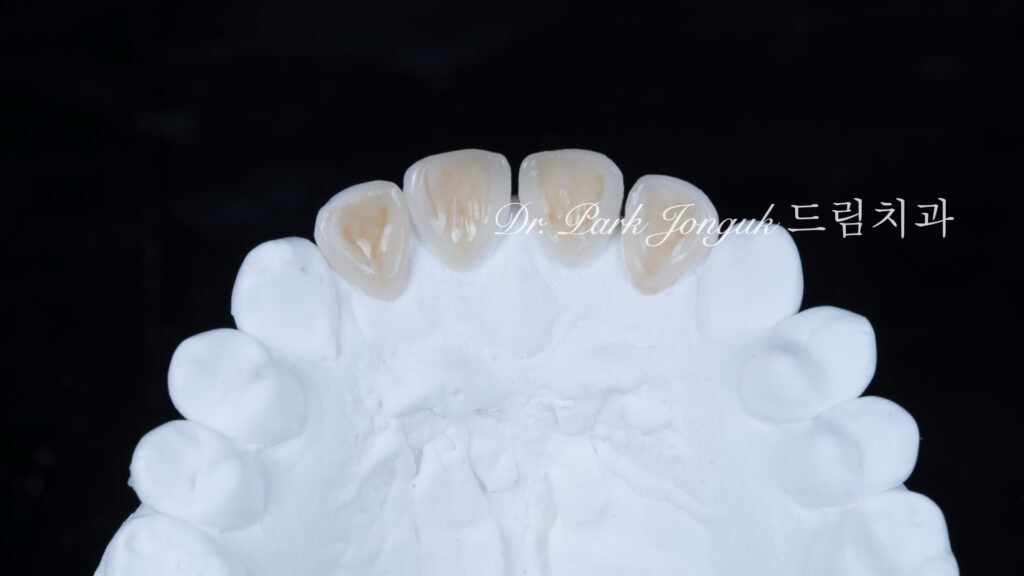 깨진 치아 라미네이트, Laminate for Fractured Teeth, 부식된 치아, Eroded Teeth, 역류성 식도염, GERD, 샌드위치 테크닉, Sandwich Technique, 무삭제 라미네이트, No-Prep Laminate, 교정 후 라미네이트, Post-Orthodontic Laminate