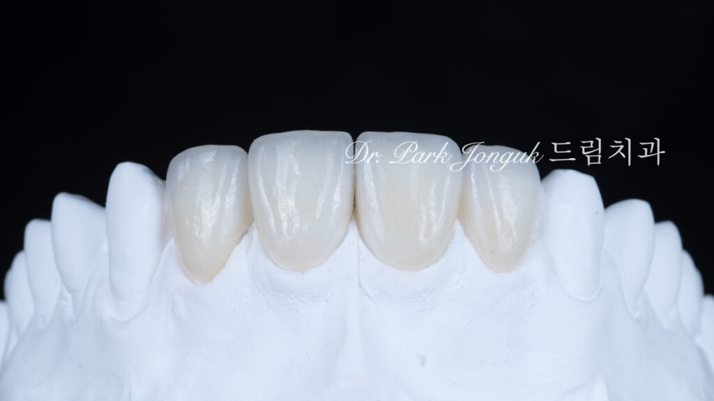 깨진 치아 라미네이트, Laminate for Fractured Teeth, 부식된 치아, Eroded Teeth, 역류성 식도염, GERD, 샌드위치 테크닉, Sandwich Technique, 무삭제 라미네이트, No-Prep Laminate, 교정 후 라미네이트, Post-Orthodontic Laminate
