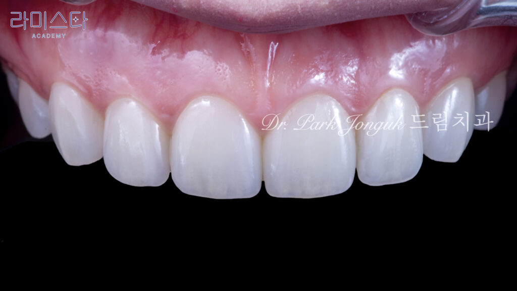앞니 라미네이트, Anterior Laminate Veneer, 라미네이트 잘하는 곳, Expert Laminate Clinic, 자연스러운 라미네이트, Natural Laminate, 다층 빌드업, Multi-Layer Build-Up, 백금박 라미네이트, Platinum Foil Veneer