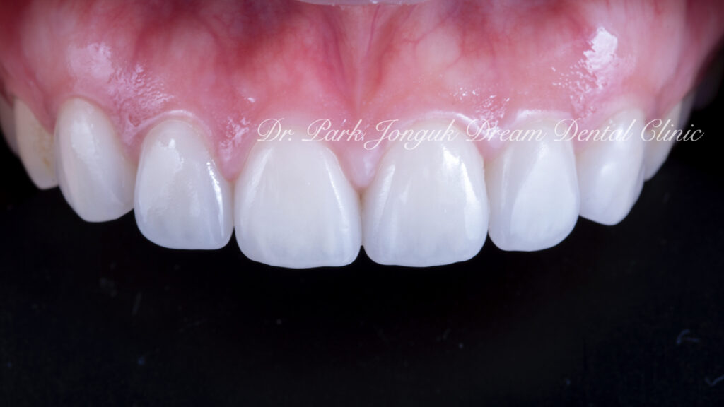 라미네이트 진단, Laminate Diagnosis, 정밀 진단, Precise Diagnosis, 얼굴 분석, Facial Analysis, 치아 비율, Tooth Proportion, 디지털 분석, Digital Analysis, 치료 예측, Treatment Prediction
