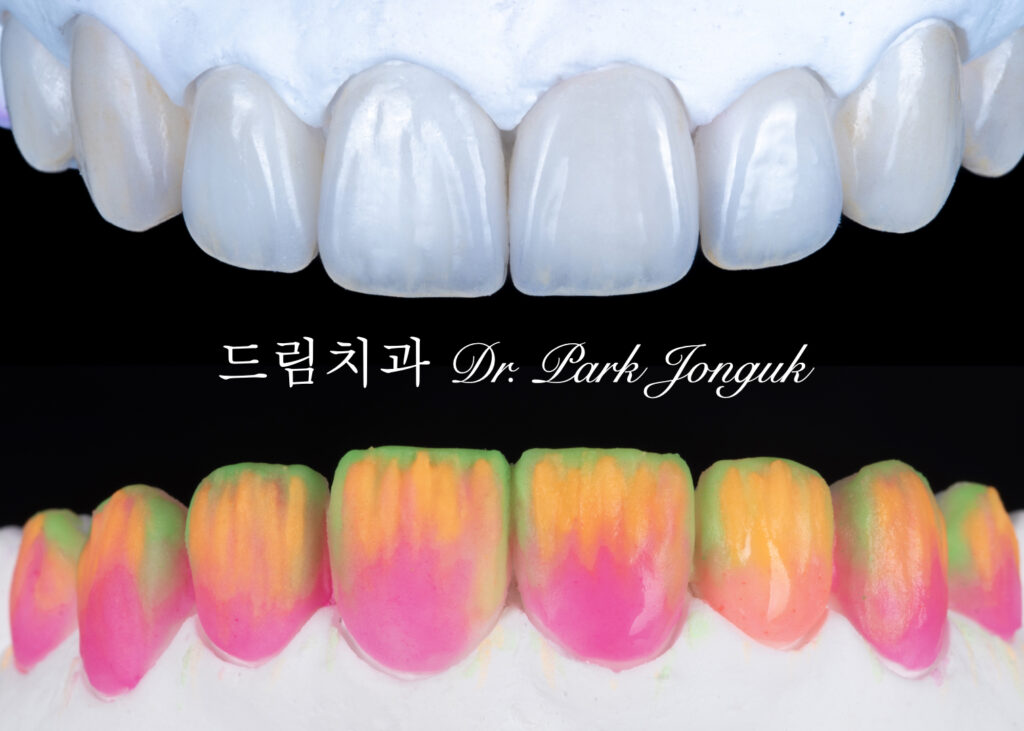 빌드업 과정이 들어가는 라미네이트 제작 과정
