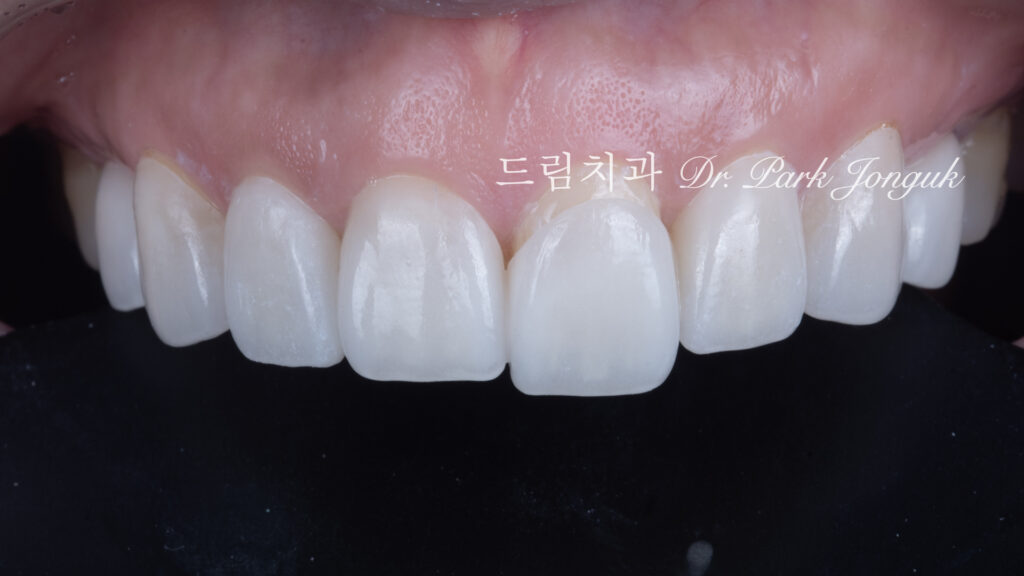 결혼식 직전에 무삭제 라미네이트 치료