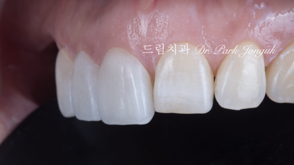 무삭제 라미네이트의 색상 변화