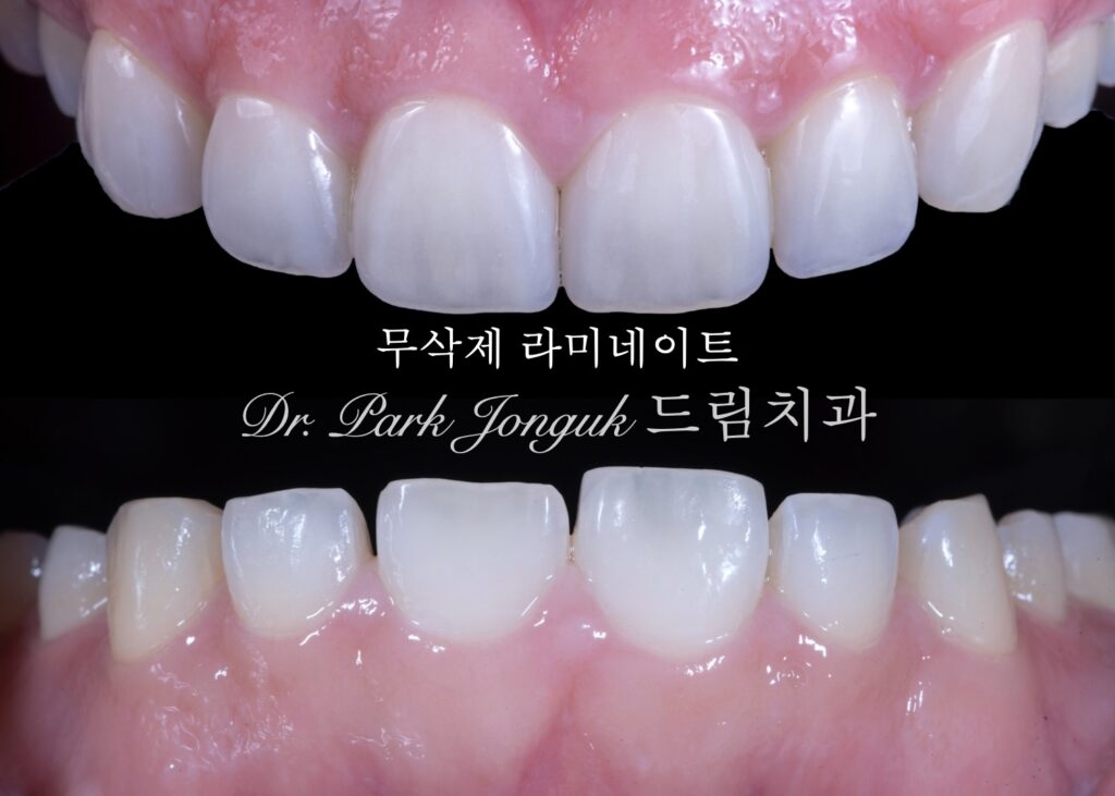 무삭제 라미네이트 전후사진