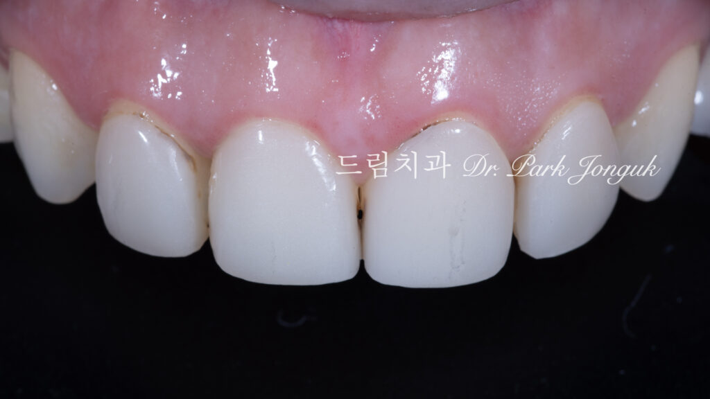레이저를 이용한 라미네이트 제거