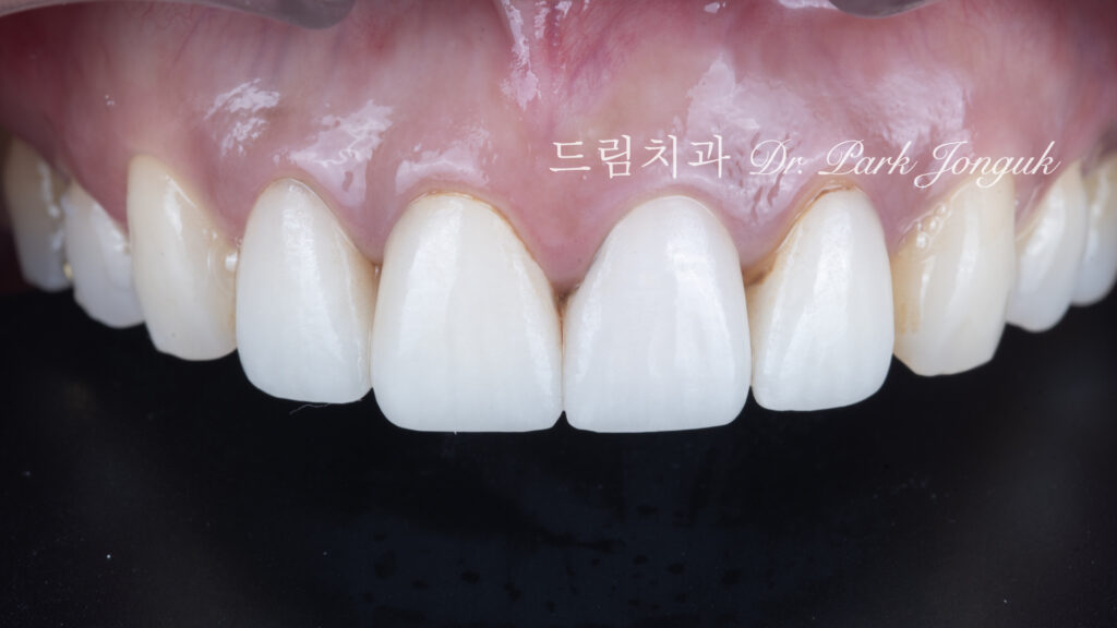 라미네이트 마진 착색