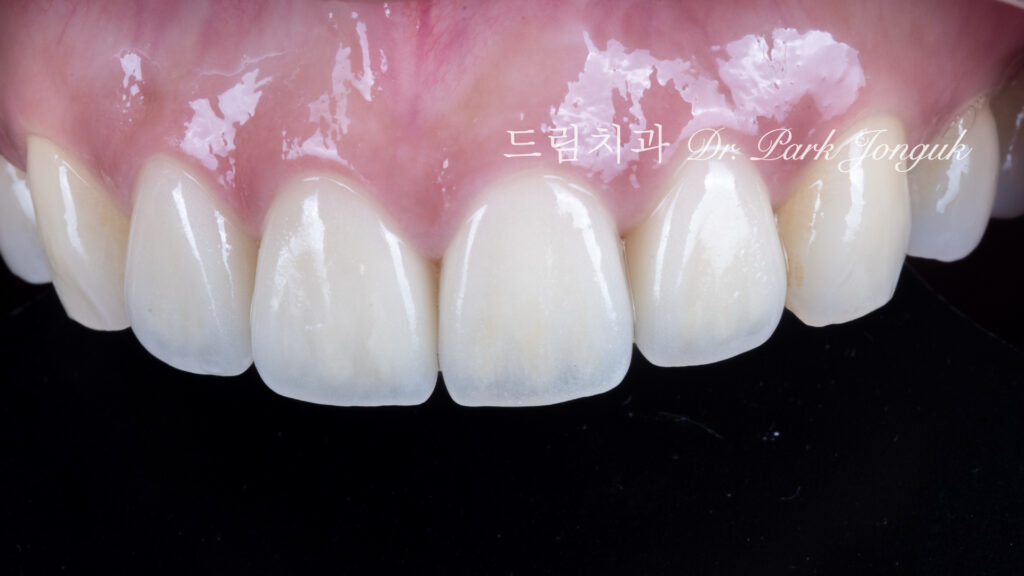 라미네이트 재시술, Laminate Retreatment, 크라운 재시술, Crown Retreatment, 올세라믹 크라운, All-Ceramic Crown, 자연스러운 크라운, Natural Crown, 투명한 라미네이트, Translucent Laminate
