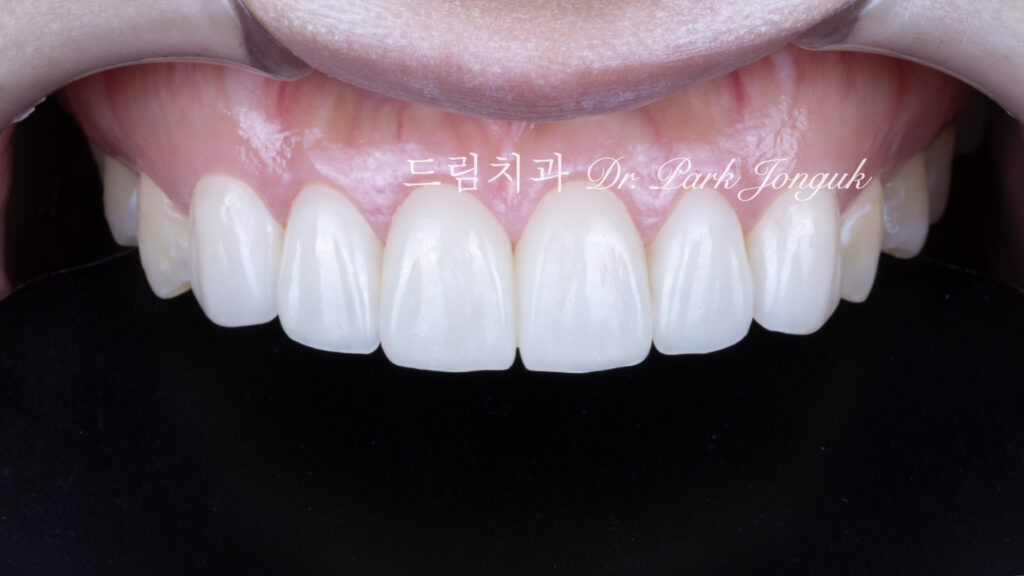 투명한 라미네이트, Translucent Laminate, 라미네이트 빌드업, Laminate Build-up, 원데이 라미네이트, One-day Laminate, 라미네이트 제작 방식, Fabrication Method, 자연스러운 라미네이트, Natural Laminate