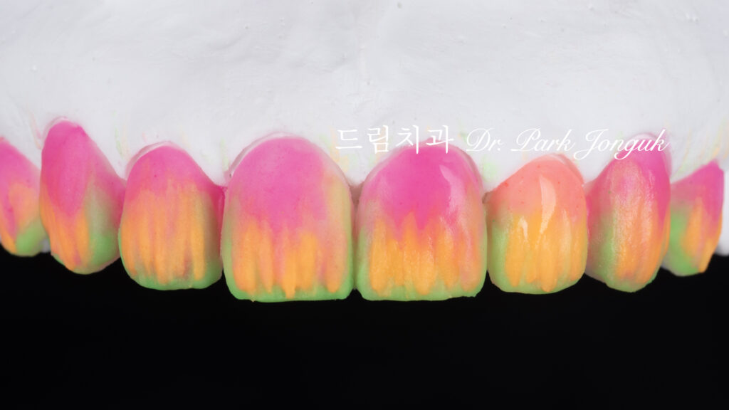 투명한 라미네이트, Translucent Laminate, 라미네이트 빌드업, Laminate Build-up, 원데이 라미네이트, One-day Laminate, 라미네이트 제작 방식, Fabrication Method, 자연스러운 라미네이트, Natural Laminate