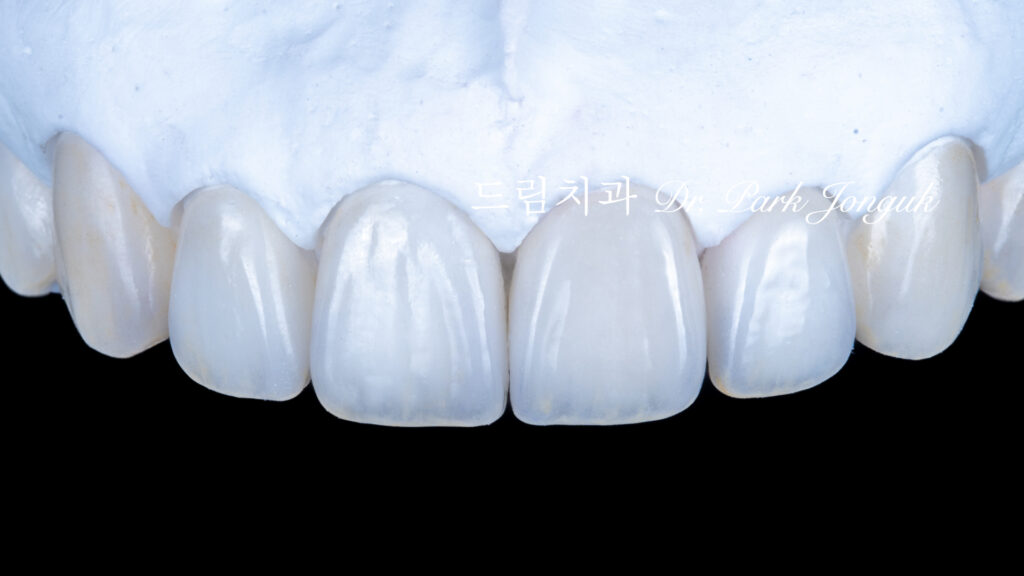 투명한 라미네이트, Translucent Laminate, 라미네이트 빌드업, Laminate Build-up, 원데이 라미네이트, One-day Laminate, 라미네이트 제작 방식, Fabrication Method, 자연스러운 라미네이트, Natural Laminate