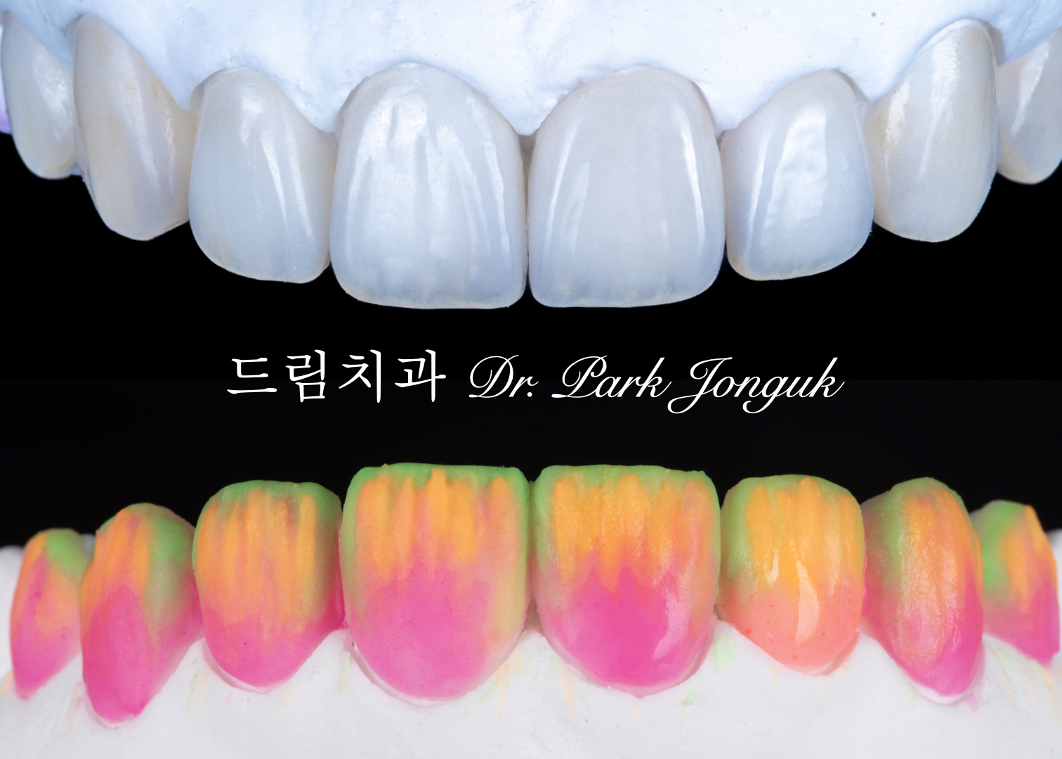 라미네이트 가격, Laminate Veneer Cost, 라미네이트 비용, Laminate Price, 라미네이트 가격 차이, 빌드업 라미네이트, Build-up Laminate, 원데이 라미네이트, One-day Laminate, 라미네이트 잘하는 곳