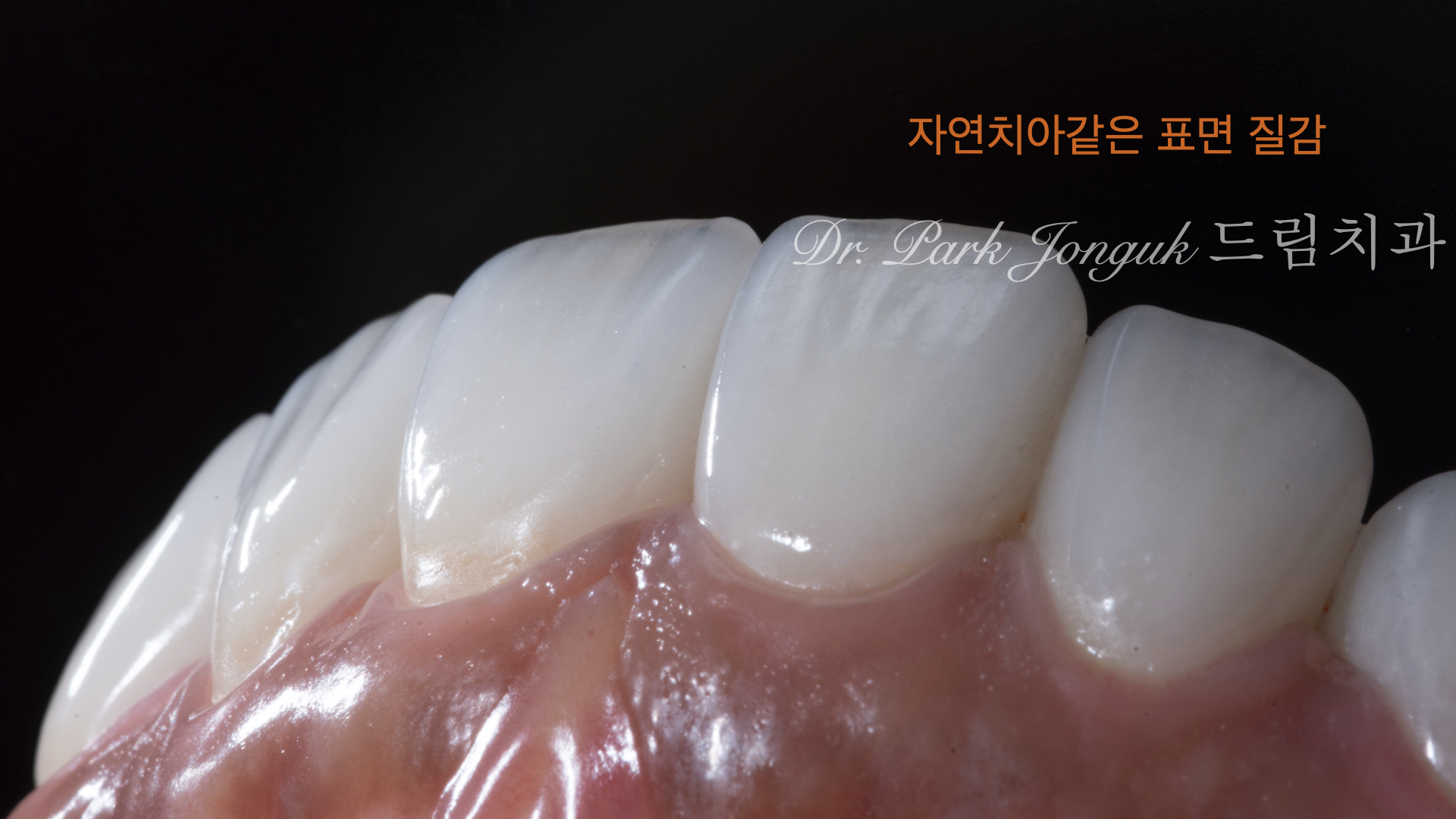 자연스러운 라미네이트