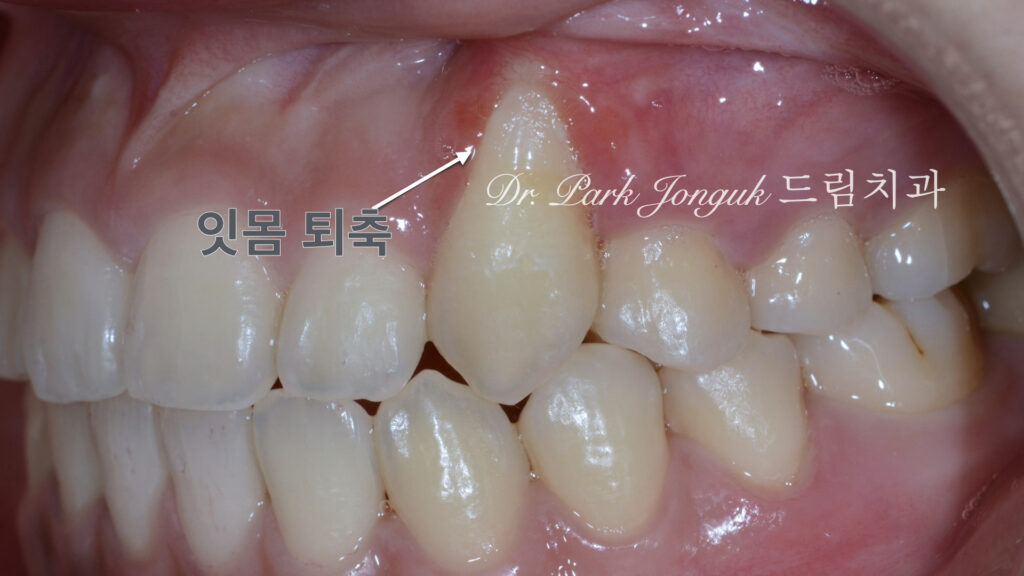 앞니 라미네이트, Anterior Laminate Veneer, 잇몸 라미네이트, Gingival Reproduction Laminate, 잇몸이 내려간 앞니, Gingival Recession, 핑크 세라믹, Pink Ceramic, 잇몸 퇴축, Recession Treatment