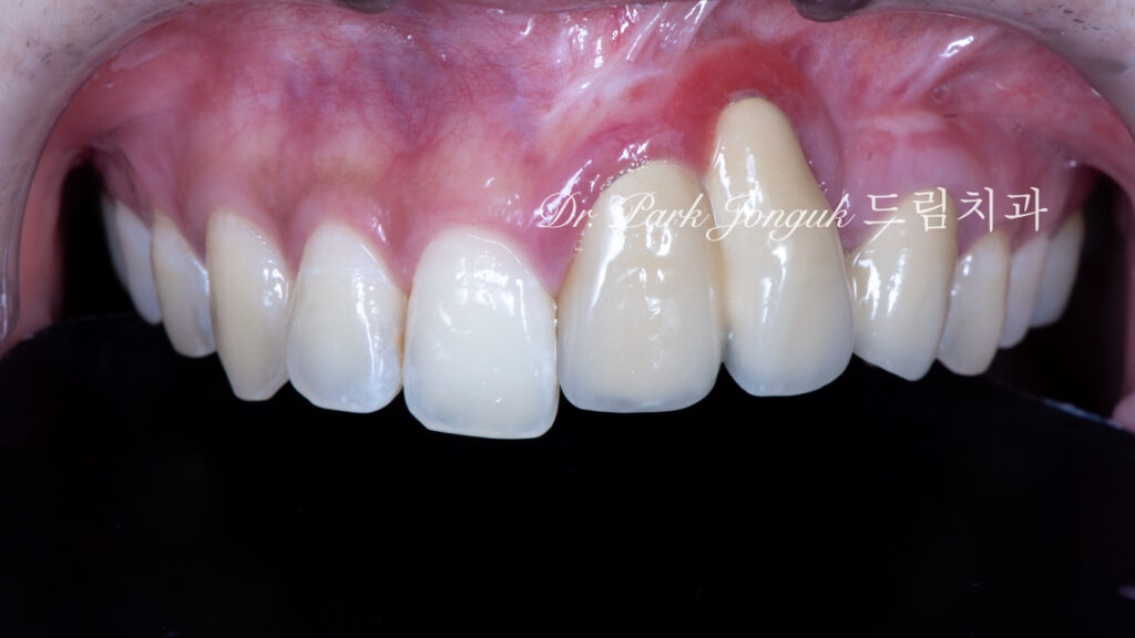 앞니 라미네이트, Anterior Laminate Veneer, 잇몸 라미네이트, Gingival Reproduction Laminate, 잇몸이 내려간 앞니, Gingival Recession, 핑크 세라믹, Pink Ceramic, 잇몸 퇴축, Recession Treatment