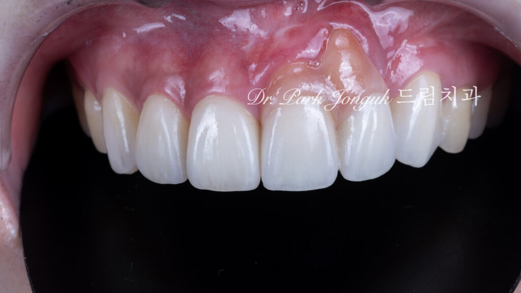 앞니 라미네이트, Anterior Laminate Veneer, 잇몸 라미네이트, Gingival Reproduction Laminate, 잇몸이 내려간 앞니, Gingival Recession, 핑크 세라믹, Pink Ceramic, 잇몸 퇴축, Recession Treatment