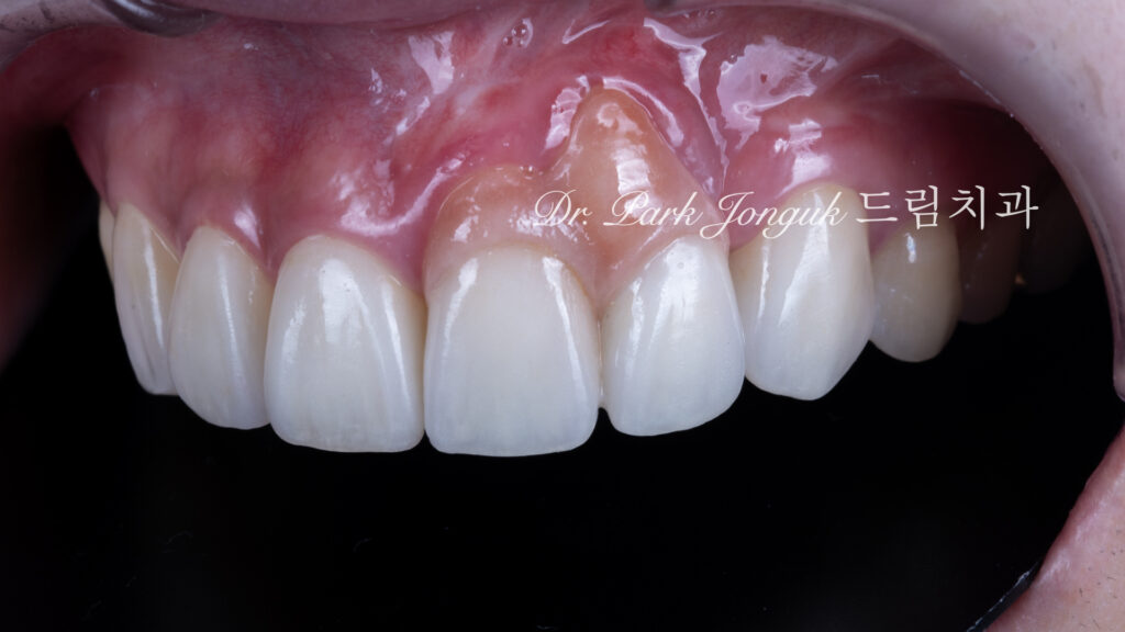앞니 라미네이트, Anterior Laminate Veneer, 잇몸 라미네이트, Gingival Reproduction Laminate, 잇몸이 내려간 앞니, Gingival Recession, 핑크 세라믹, Pink Ceramic, 잇몸 퇴축, Recession Treatment