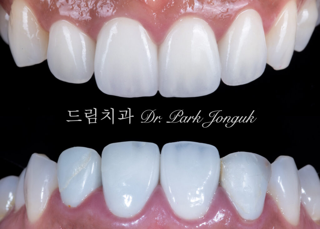 라미네이트와 올세라믹 크라운 파절로 재치료를 진행한 케이스