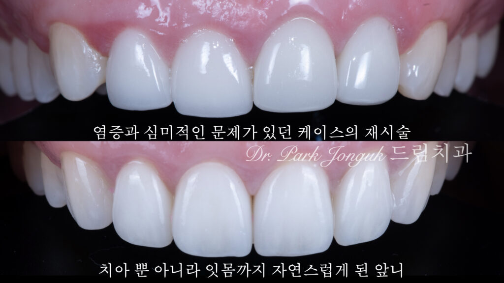 염증과 치열의 변화로 라미네이트 재치료