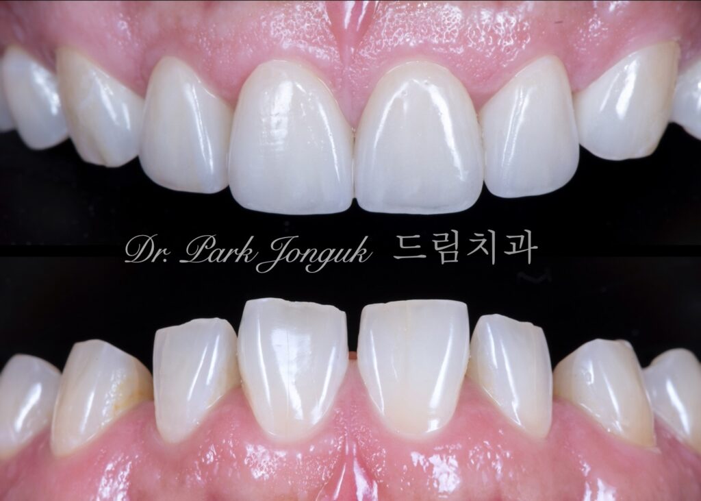 최소한의 삭제만으로 자연스러운 치아의 느낌을 살려낸 라미네이트