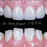 최소한의 삭제만으로 자연스러운 치아의 느낌을 살려낸 라미네이트