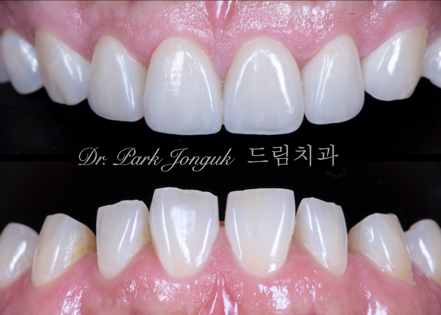 최소한의 삭제만으로 자연스러운 치아의 느낌을 살려낸 라미네이트