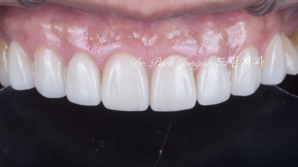 노화 치아 라미네이트, Aging Tooth Laminate, 50대 라미네이트, 60대 라미네이트, 법랑질 손실, Enamel Loss, Biomimetic, 생체모방 치과학, 치아 노화, Tooth Aging