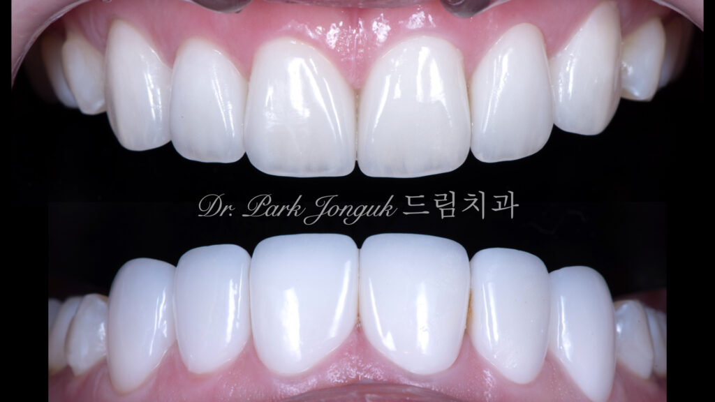 너무 하얀 치아에 대한 재치료
